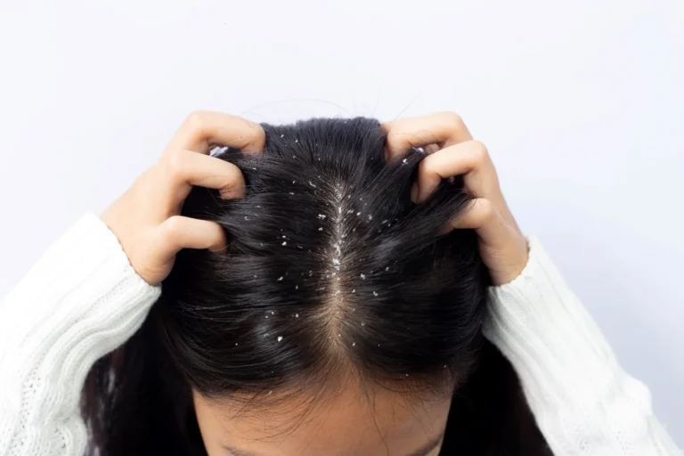 Here's How To Really Deal With Dandruff
