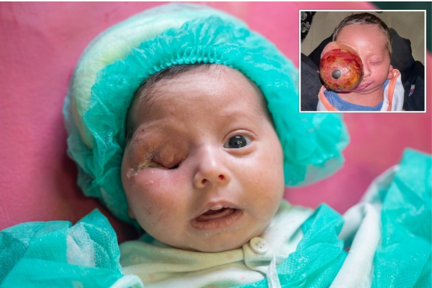 Pakistan reports first documented 285-gram congenital eye tumor in newborn