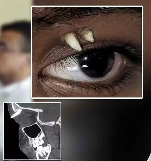 Rare Medical Case in India: Tooth Discovered Inside 16-Year-Old Boy’s Eye Socket